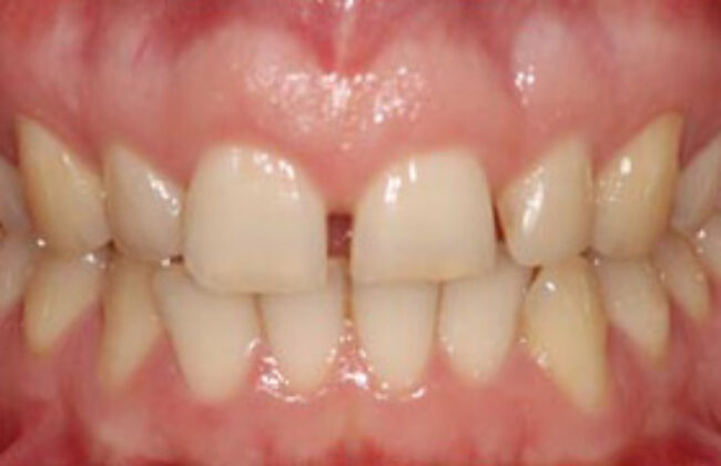 Before (Teeth)