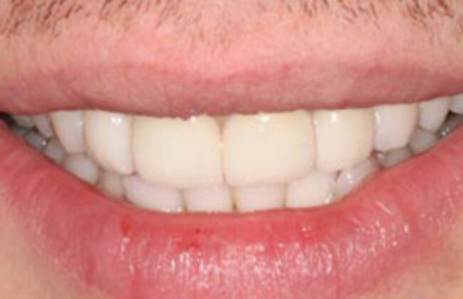 After (Teeth)