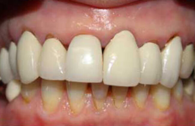 Before (Teeth)