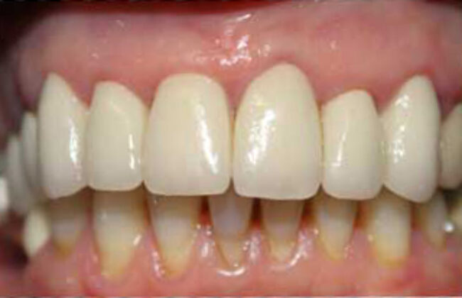 After (Teeth)