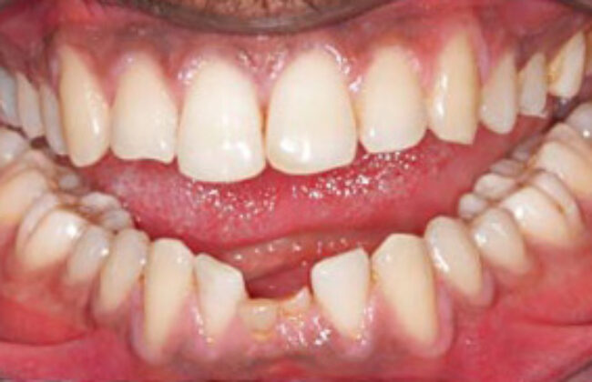 Before (Teeth)