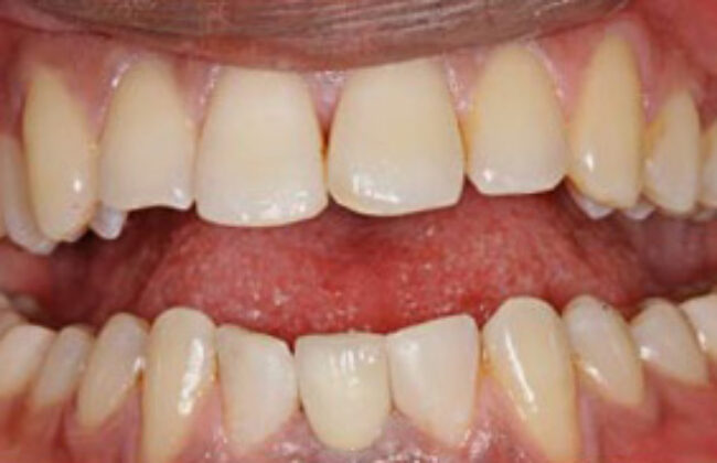 After (Teeth)