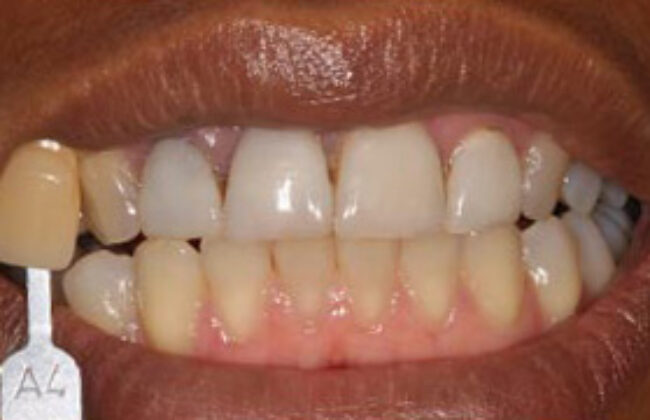 Before (Teeth)