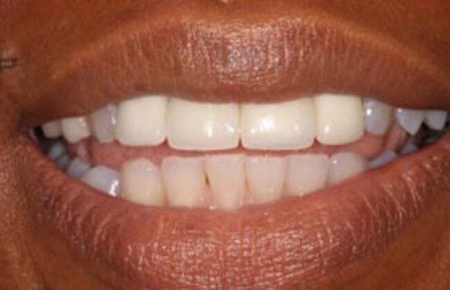 After (Teeth)
