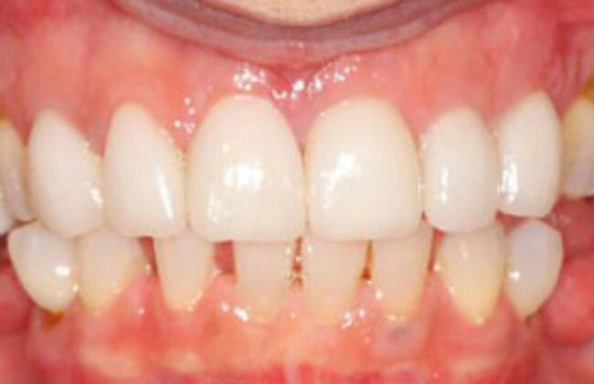 After (Teeth)