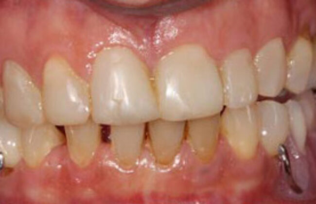 Before (Teeth)
