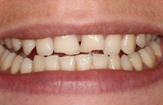 Before (Teeth)