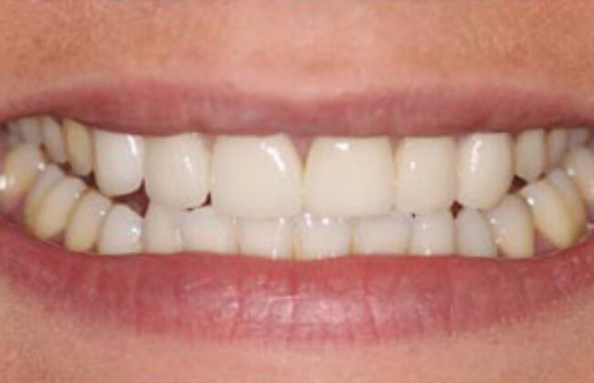 After (Teeth)