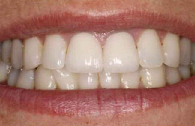 After (Teeth)