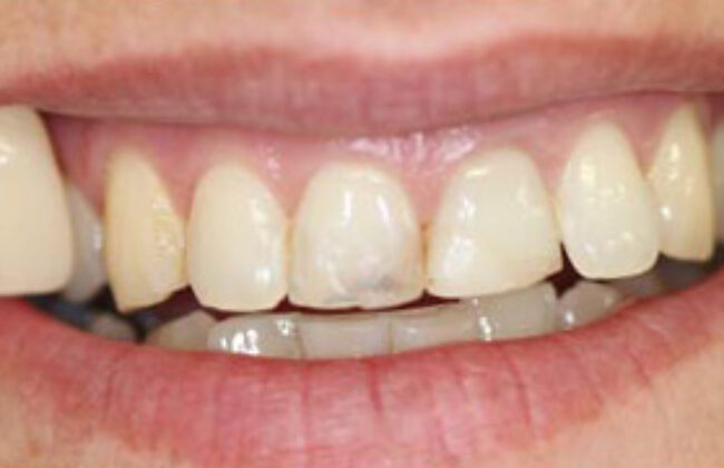 Before (Teeth)