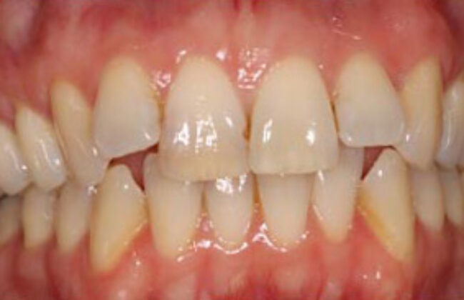 Before (Teeth)