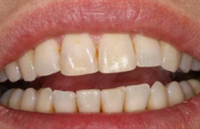 After (Teeth)