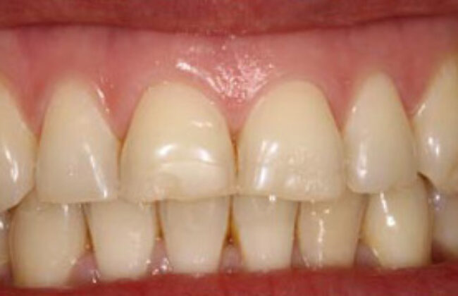 Before (Teeth)