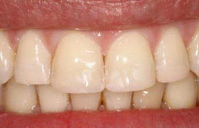 After (Teeth)