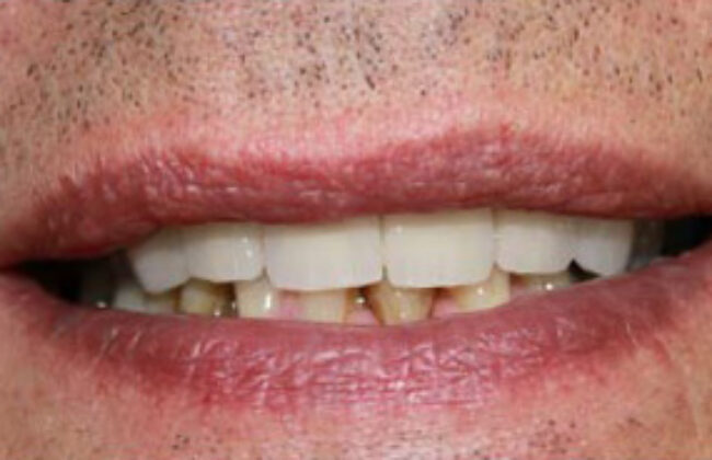 After (Teeth)