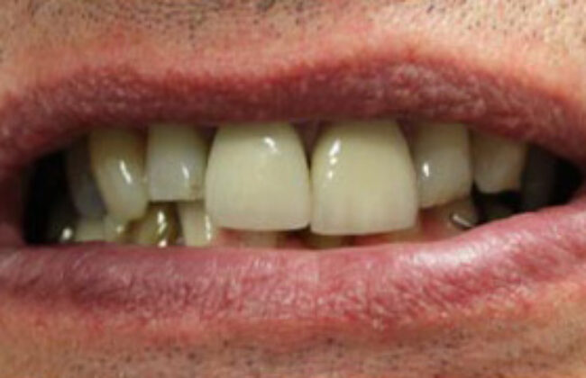 Before (Teeth)