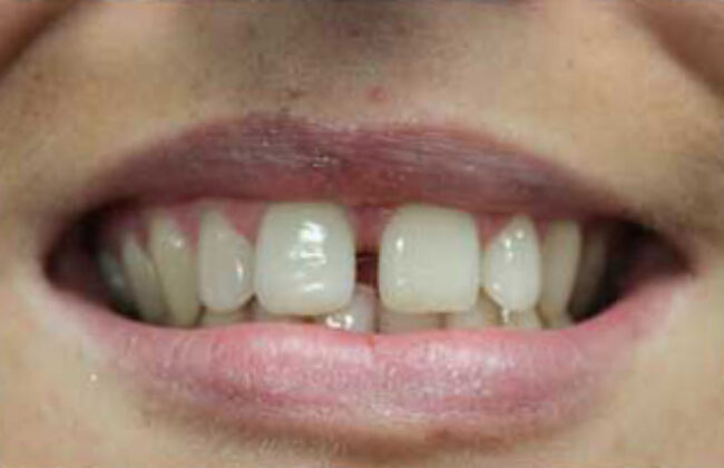 Before (Teeth)
