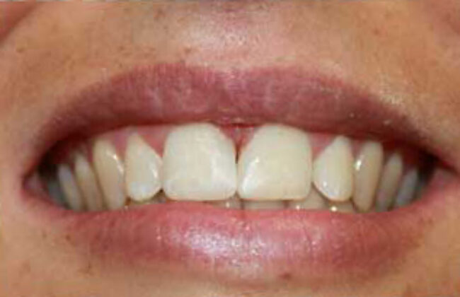 After (Teeth)