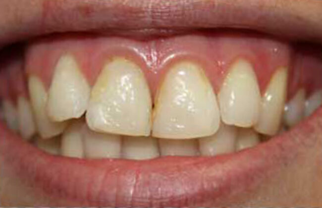 Before (Teeth)