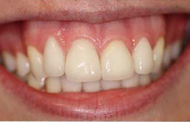 After (Teeth)
