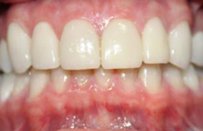 After (Teeth)