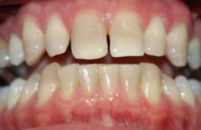 Before (Teeth)
