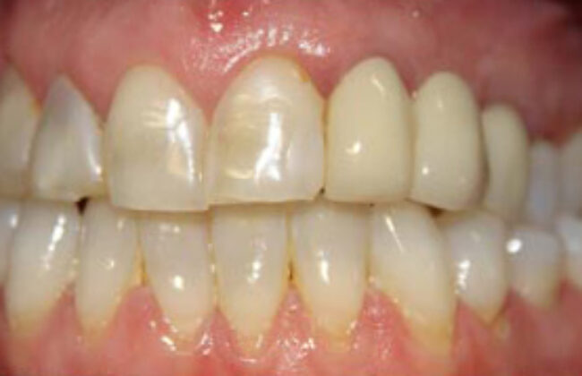 Before (Teeth)