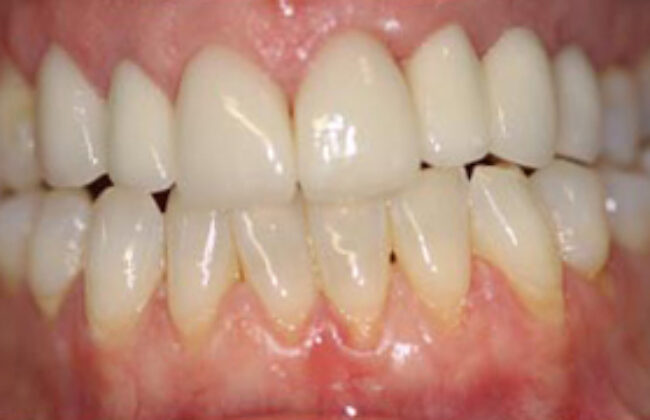 After (Teeth)