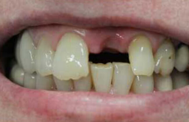 Before (Teeth)