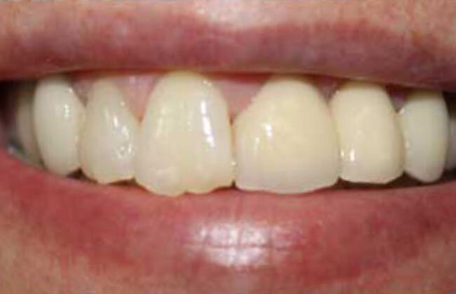 After (Teeth)