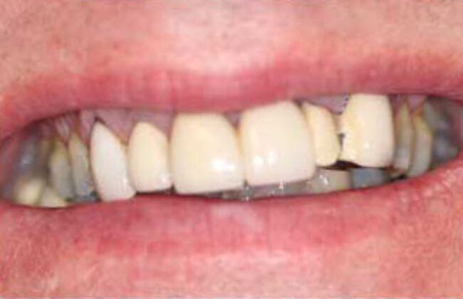 Before (Teeth)