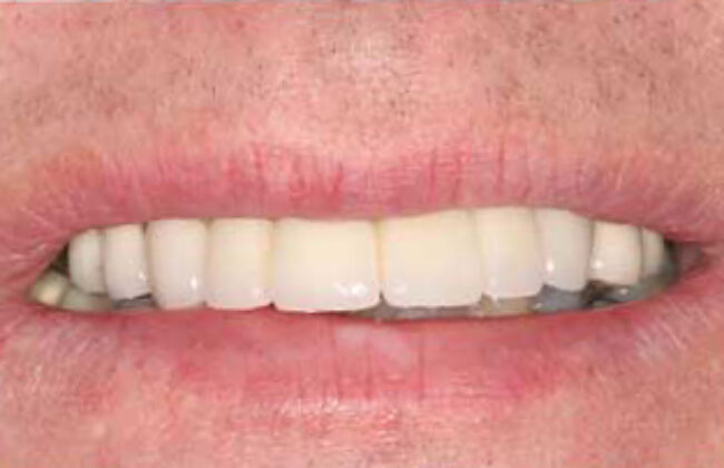 After (Teeth)