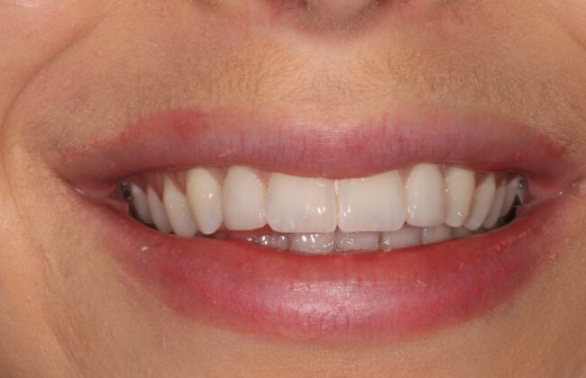 After (Teeth)
