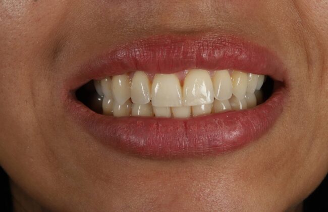 After (Teeth)