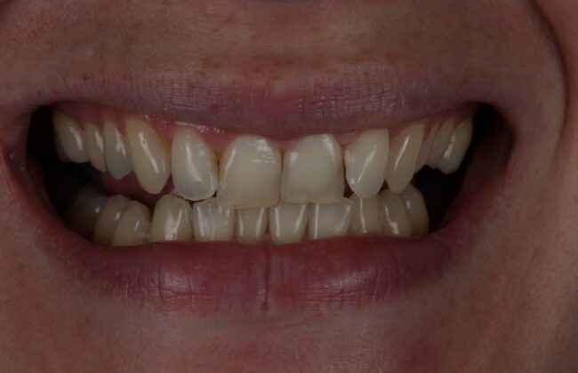 Before (Teeth)