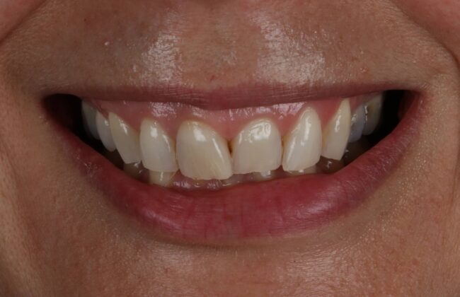 Before (Teeth)