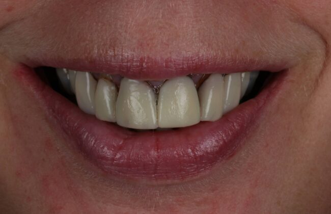 Before (Teeth)