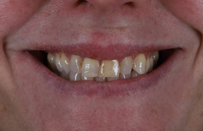 Before (Teeth)