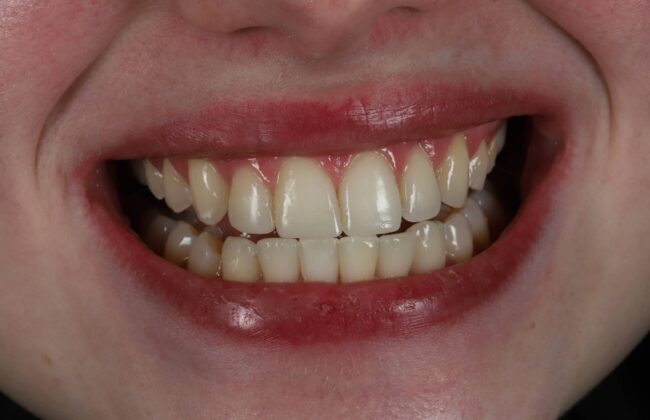 After (Teeth)