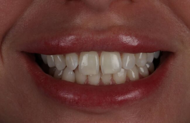 Before (Teeth)