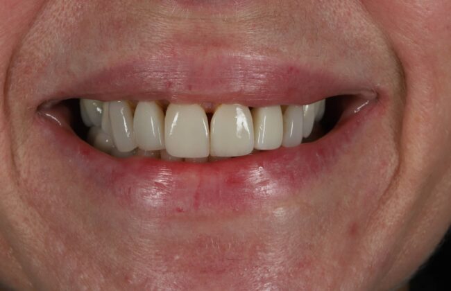 Before (Teeth)