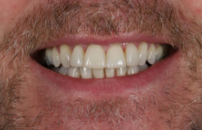 After (Teeth)