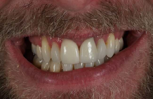 After (Teeth)
