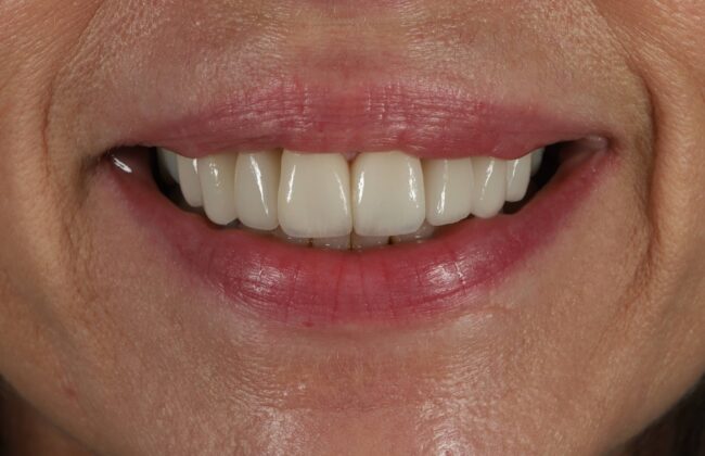 After (Teeth)