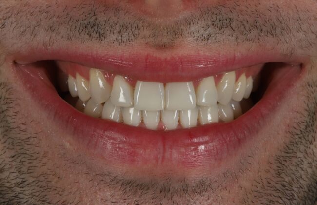 After (Teeth)