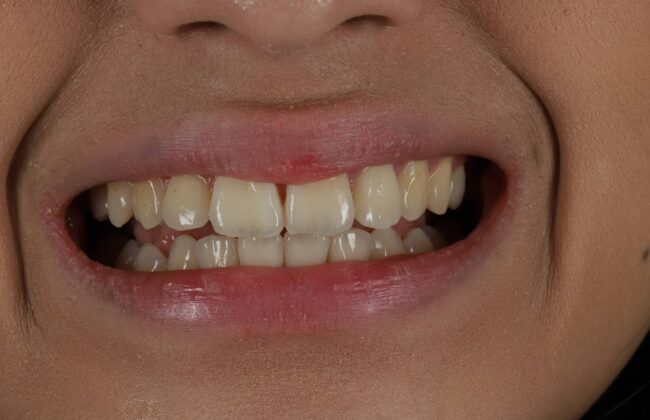 After (Teeth)