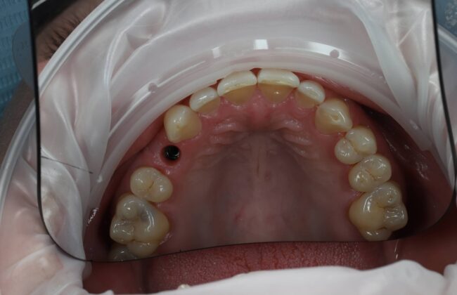 After (Teeth)