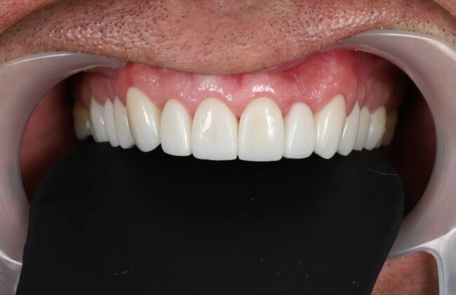 After (Teeth)