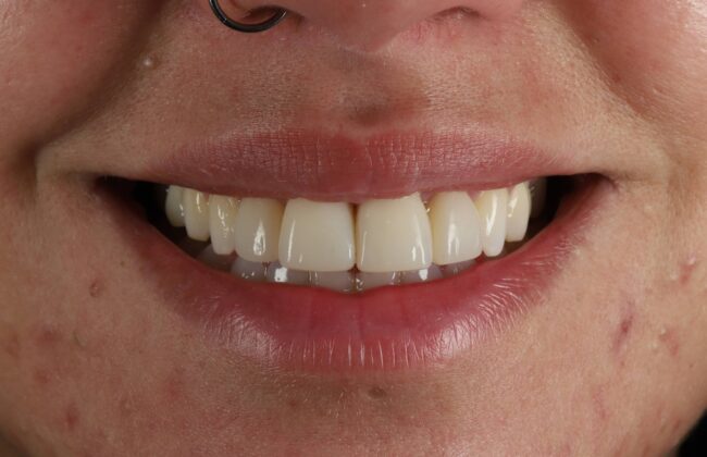 After (Teeth)