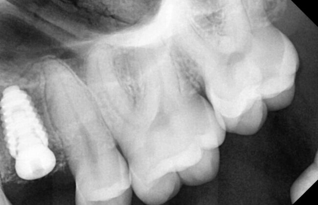 Before (Teeth)